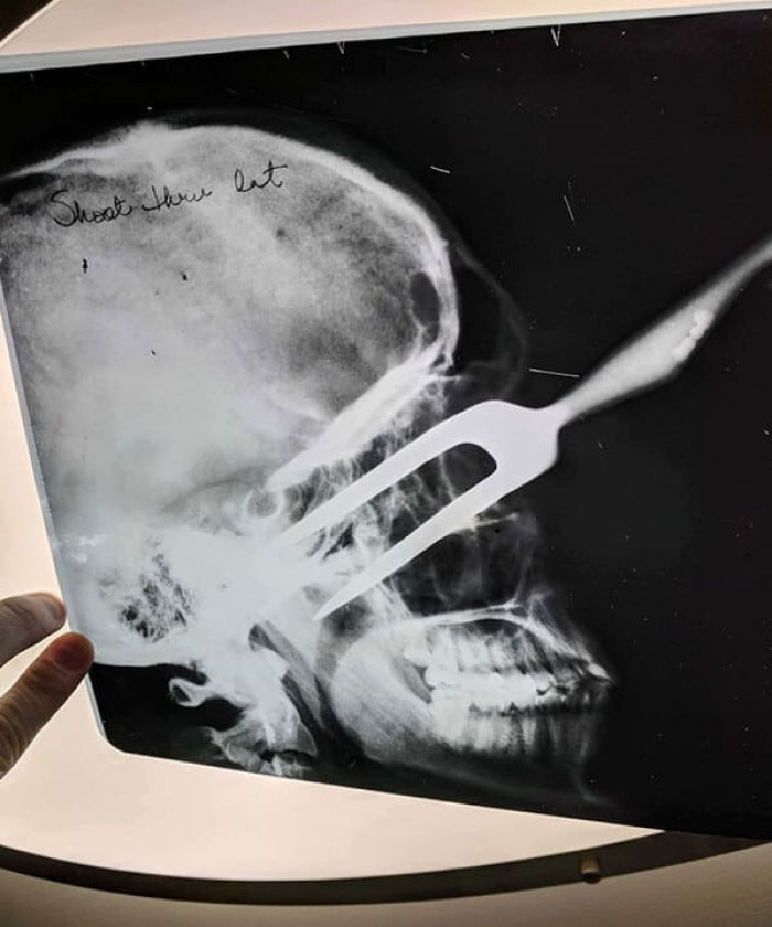 9. New owner found some old x-rays in the house. That looks painful.