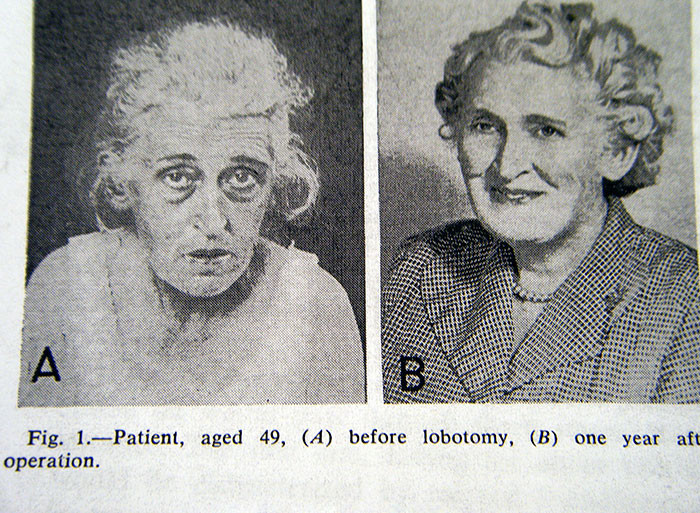 lobotomy before and after brain