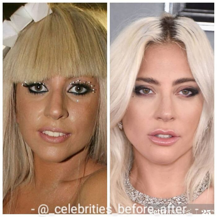 3. Lady Gaga's before and after photos