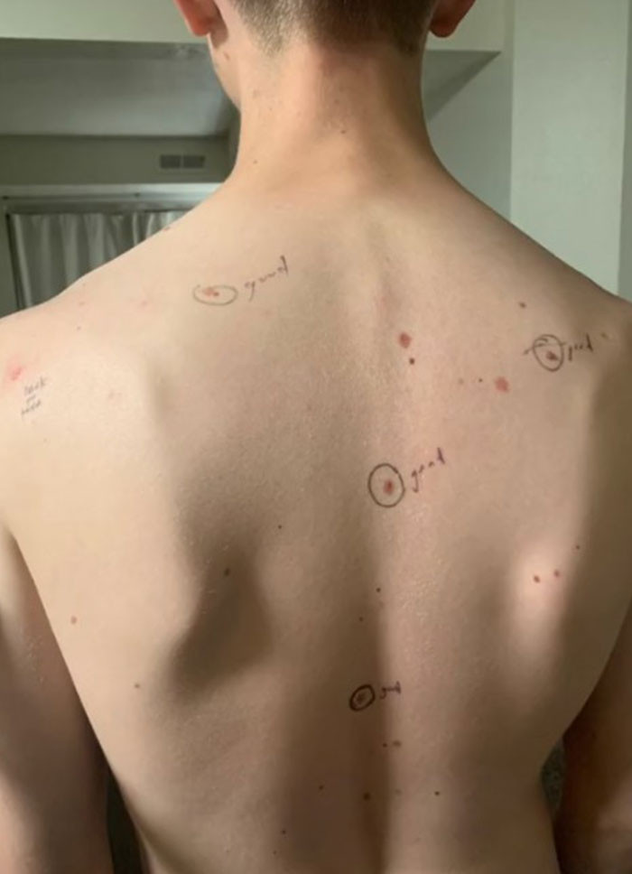 The doctor had made notes on Ryan's chest and back, next to each of Brinlee's circles.