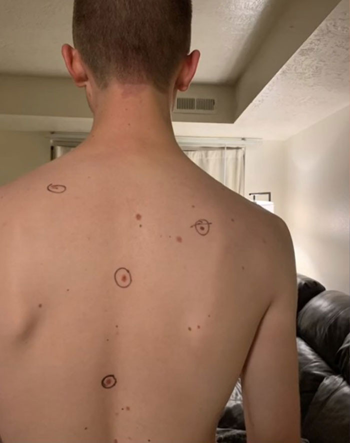The 20-year-old woman from Utah shared photos of her husband Ryan's body covered in circles.