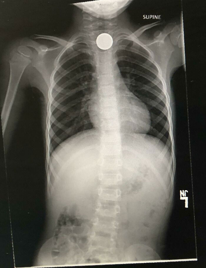Kid swallows a nickel, and parents had to pay $4,400 to have it removed.