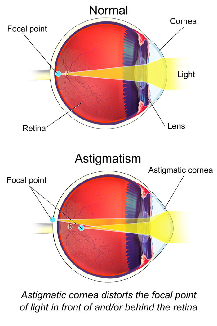 Astigmatism - Simptome și tratament - Ochelari 