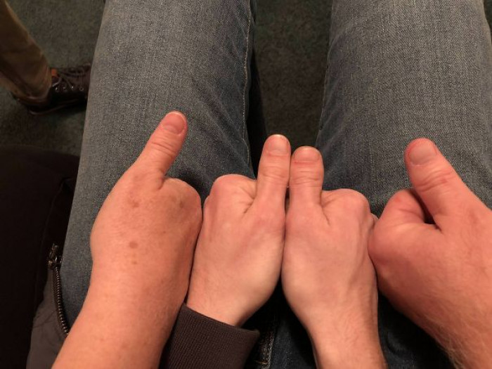 “My Brother-In-Law Got A Thumb From Each Parent”