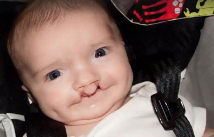 He Has Had Six Surgeries So Far to Repair His Cleft Lip