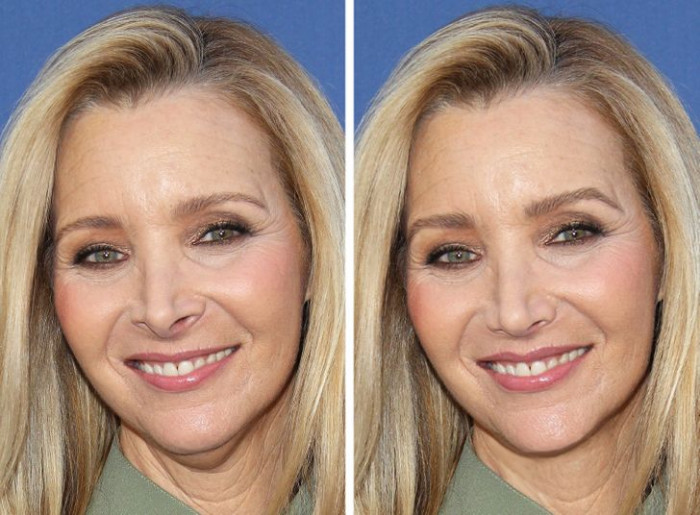 15. Lisa Kudrow has got her brows, nose and neck lines fixed