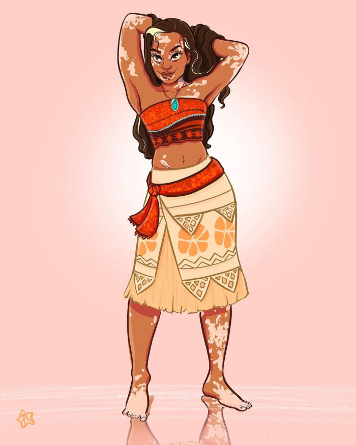 1. Here is Moana with Vitiligo