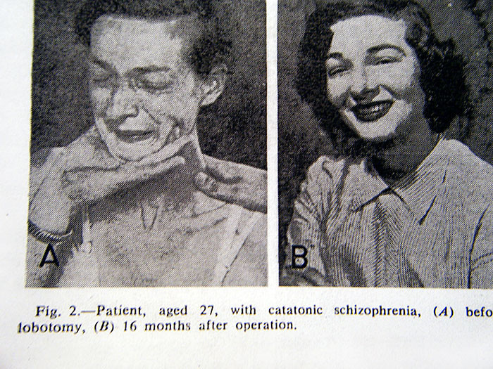 Disturbing Before And After Photos of Lobotomy Patients Will Leave You ...