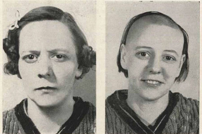 Disturbing Before And After Photos of Lobotomy Patients Will Leave You ...