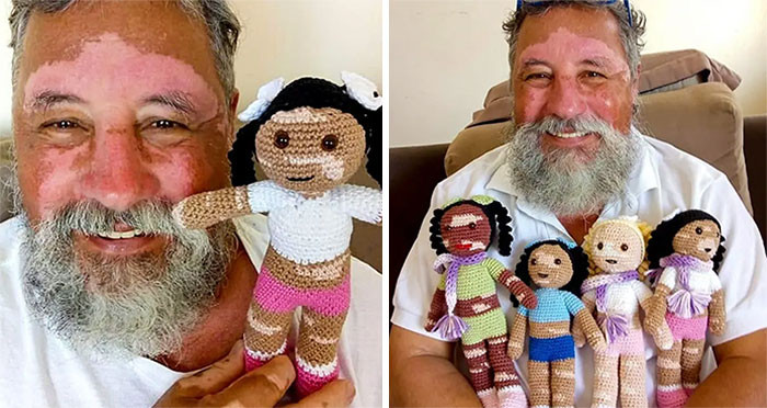 21. A man suffering from vitiligo creates dolls to make kids with the same condition feel better.