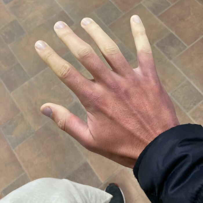 48. I Have This Thing Called Raynaud’s Disease. This Happens Every Time I Get Cold