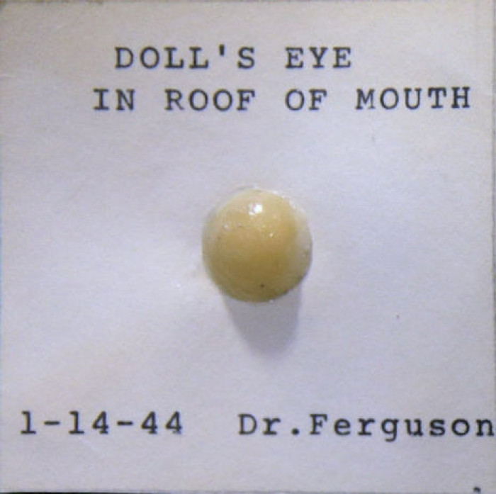 Doll's eye removed from young patients mouth in 1944