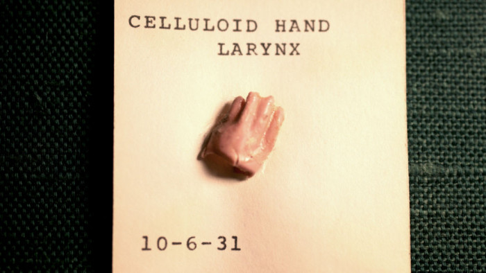 Doll's hand removed from the larynx of a child in 1931