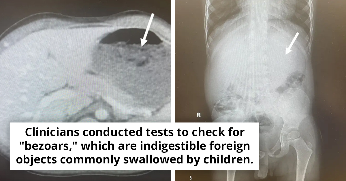 What Happened When My 5-Year-Old Swallowed 40 Pieces Gum