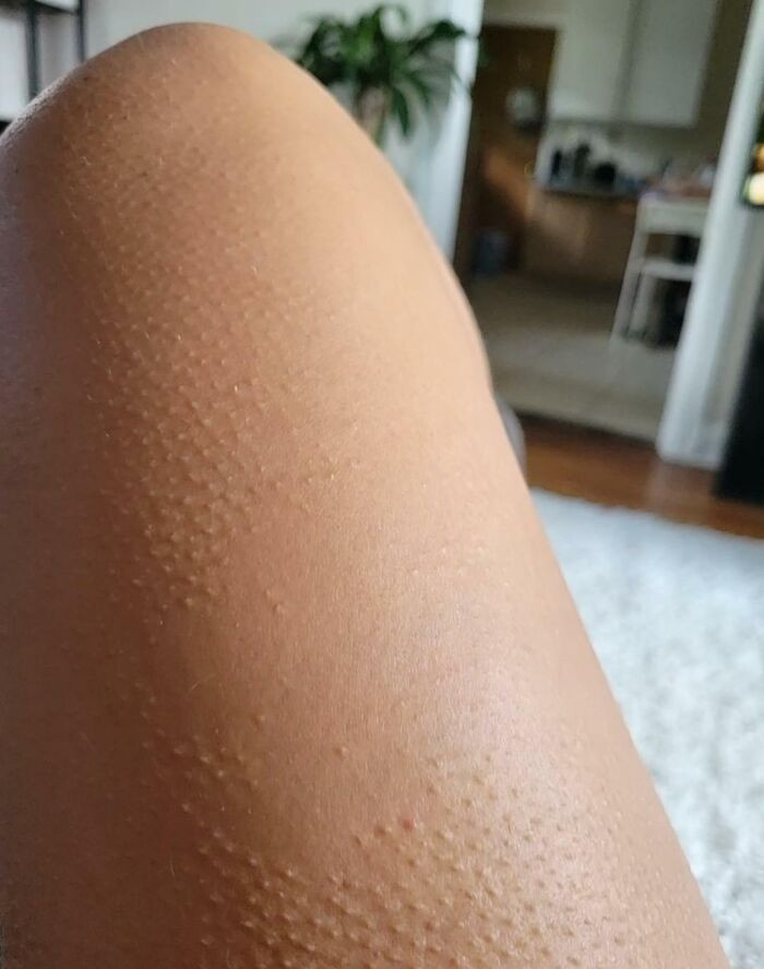 27. There's A Patch On My Leg That Doesn't Get Goosebumps