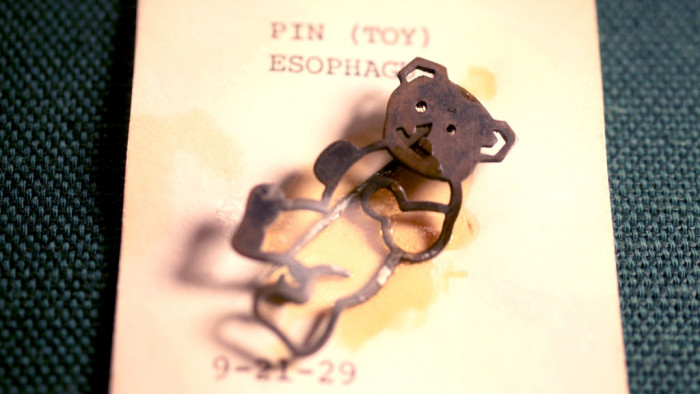 A toy pin recovered from a child’s esophagus in 1929.