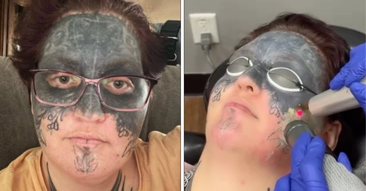 Woman Receives Life-Changing Tattoo Removal Surgery After Being Inked Against Her Will