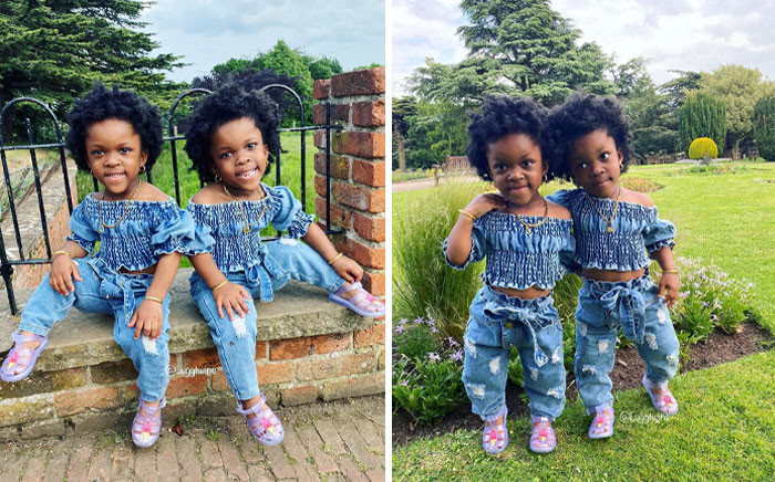 45. Twin Girls Have Achondroplasia. This Genetic Disorder Is Characterized By A Large Head, Short Arms And Legs, Short Stature, Prominent Forehead, And Flat Nasal Bridge