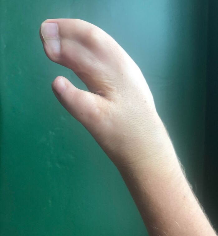 21. Here’s A Picture Of The Hand I Was Born With