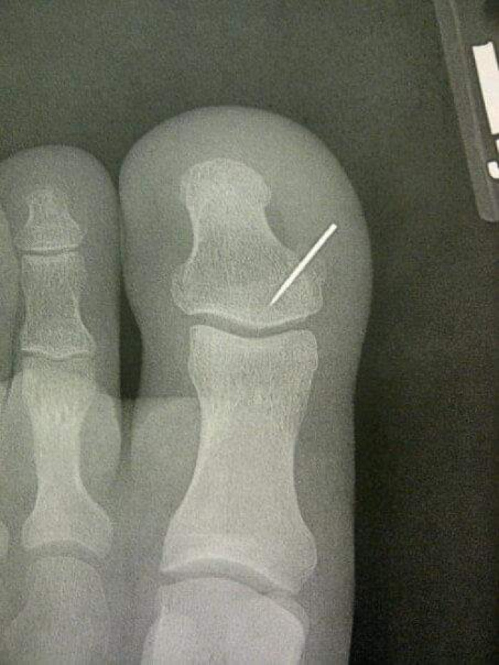 33. Wife lost a sewing needle in the carpet and I found it a few days later...