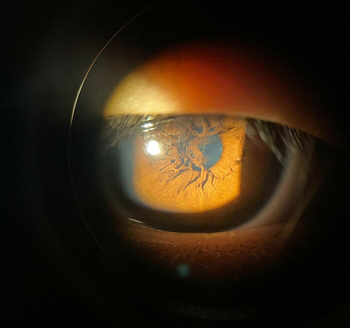 34. Interesting Iris Pattern (It Doesn’t Affect Vision)