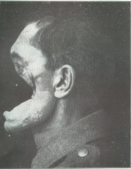 4. Horrifying (and nearly fatal) facial injuries to a German soldier in World War I