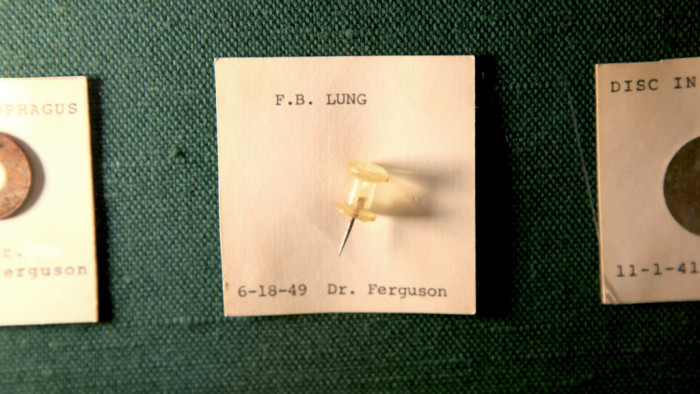 A thumbtack recovered from a child’s lung in 1949