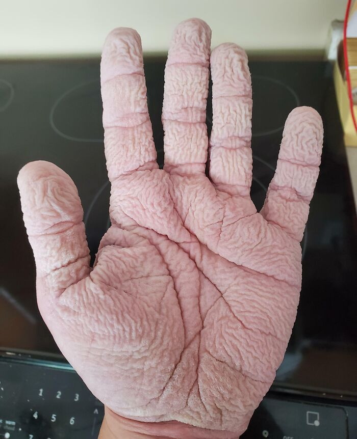 7. My Hands After Washing The Dishes For 20 Minutes